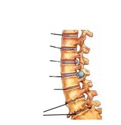 етапи на развитие на остеохондроза